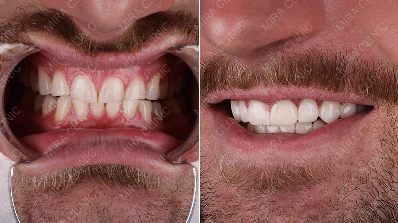 Hollywood smile Before and After
